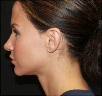 Ultherapy after 434702