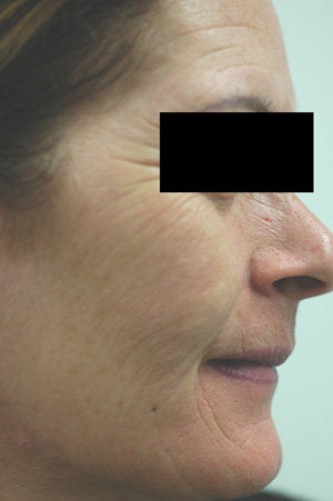 Photofacial after 151338