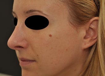 Non-surgical rhinoplasty after 182427