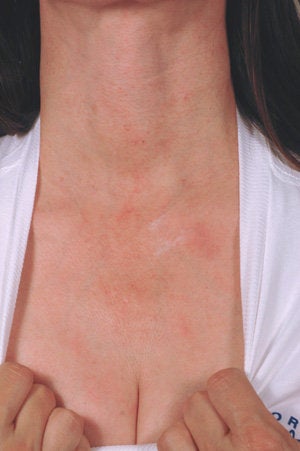 Laser treatment for neck and chest sun damage before 199408