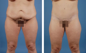 Lower Body Lift and Liposuction of Lateral Thighs before 303681