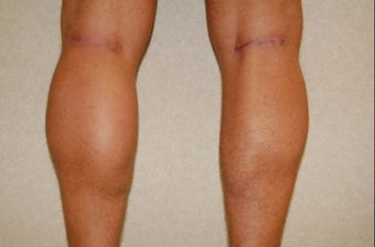 calf implants after 258894