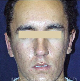 Bilateral Otoplasty (EAR-SET BACK) after 147640