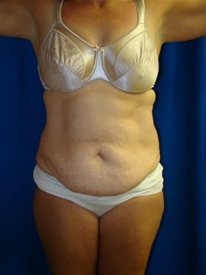 Tummy Tuck Surgery (abdominoplasty) and Liposuction before 119470