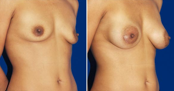 Breast Implants after 494489