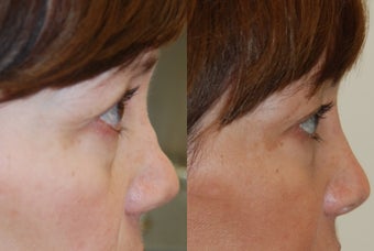 Non-Surgical Rhinoplasty with Silikon-1000. Profile refinement after previous rhinoplasty surgery. before 354517