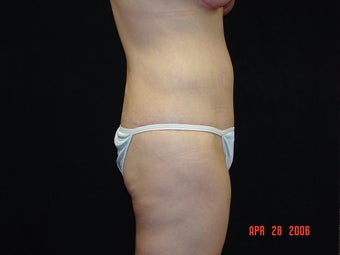 Body Lift with Liposuction of Abdomen, Waist, and Flanks after 203455