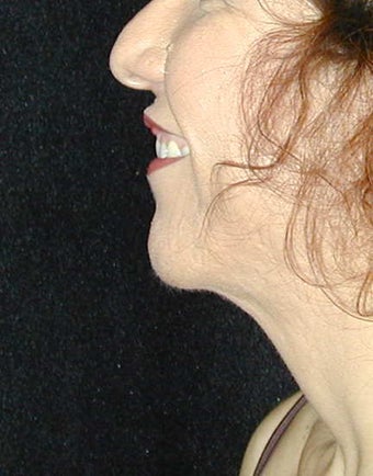 Chin Surgery after 101321