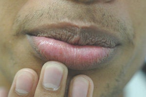 Brown Spots on the Lips after 179156