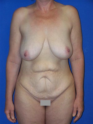 Abdominoplasty with breast lift surgery before 121141