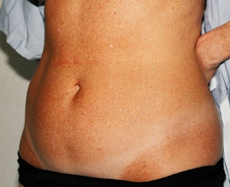 Mini-abdominoplasty 493653