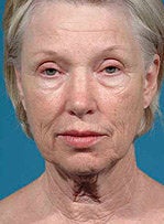 Facelift, eyelid surgery, neck & brow lift before 458802