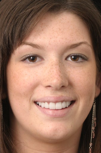 Porcelain Veneers after 399426