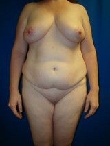 Breast Reduction, Mommy Makeover, Tummy Tuck (Abdominoplasty) before 412073