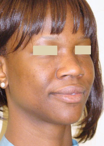 African American Rhinoplasty before 104226