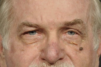 Eyelid Lift after 293526