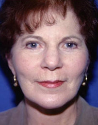 Facelift and Eyelid Surgery after 316338