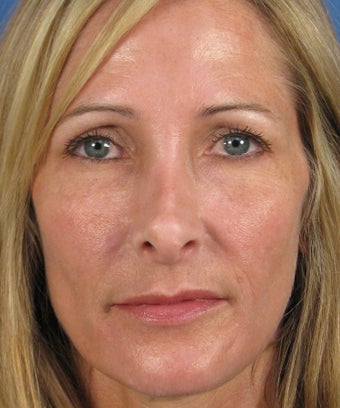 Revision Rhinoplasty before 410807