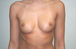 Breast Augmentation before 233360