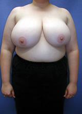 Breast Reduction before 96853