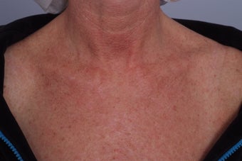 Laser treatment to Chest before 253107