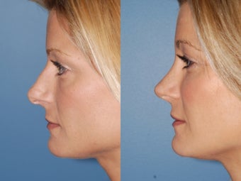 Revision rhinoplasty after 334284