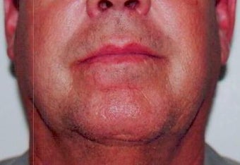 Scar Revision after 236057