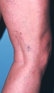 Sclerotherapy before 370426