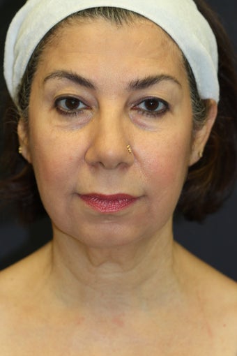 Chin Augmentation with upper/lower blepharoplasty, facelift, radiesse, and buccal fat removal before 527535