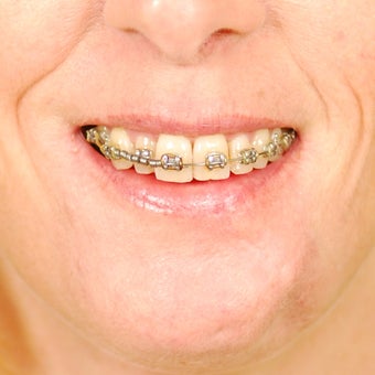 Scar Revision - Lower Lip after 492308