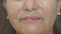 Perlane and Botox for mouth lines after 91299