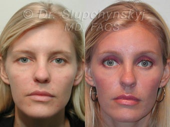 Endoscopic Brow Lift before 615729