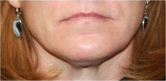 Lip augmentation - juvederm before 435618