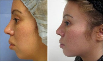 Chin Augmentation before 512847