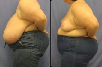 Breast Reduction after 160540