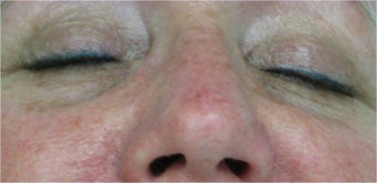 Juvederm for lower eyelid hollows before 77466