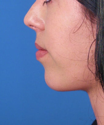 Chin Implant 534045