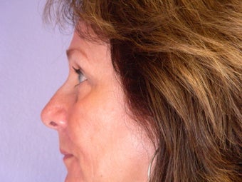 Eyelid Surgery after 306444