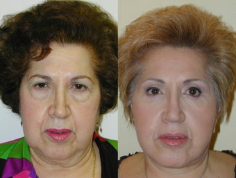 Composite Facelift, Upper and Lower Blepharoplasty before 142436