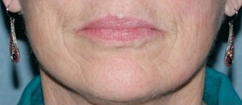 Fractional CO2 Laser Treatment before 374383