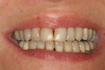 Porcelain Veneers before 213080