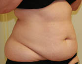 Abdominoplasty (Tummy Tuck) before 216672