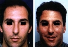 Hair replacement with Fleming/Mayer flap before 143620