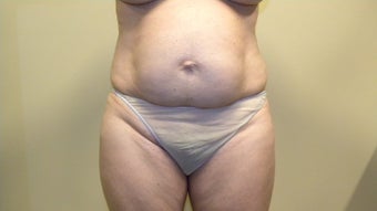 Abdominoplasty (Tummy-tuck) before 402723