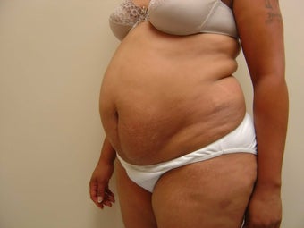 Tummy Tuck before 504651