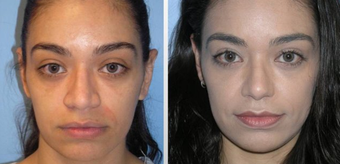 Rhinoplasty before 163639