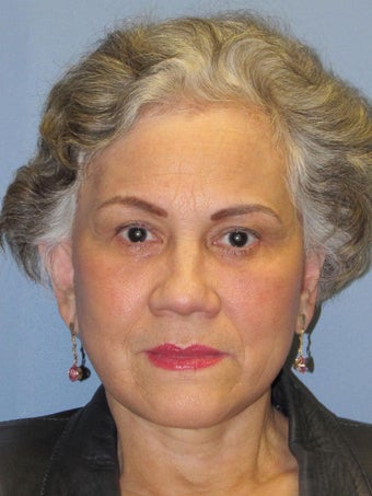 Brow Lift after 505142
