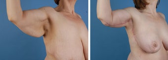 Arm lift (Brachioplasty) after 303698
