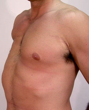 Male Chest Enhancement before 525473