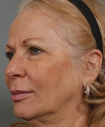 Sculptra after 277735